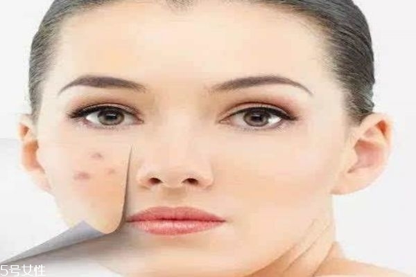 痘痘肌應該用什么面膜呢 痘痘肌適合什么洗面奶呢 痘痘肌應該用什么面膜呢 痘痘肌適合什么洗面奶呢