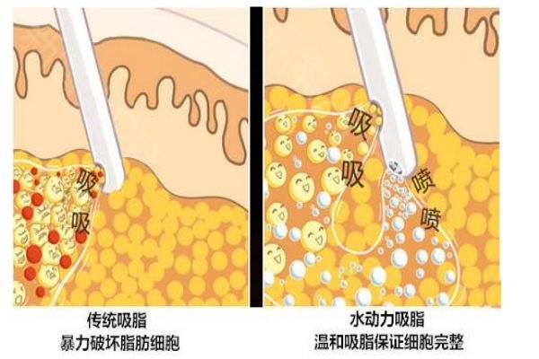 什么是水動力吸脂呢 水動力吸脂有什么用呢 什么是水動力吸脂呢 水動力吸脂有什么用呢