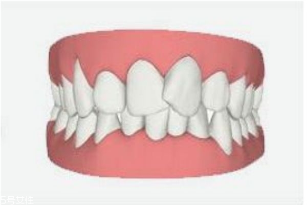 牙齒泛黃應該怎么辦呢 為什么牙齒會泛黃 牙齒泛黃應該怎么辦呢 為什么牙齒會泛黃