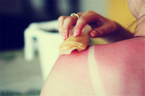 曬傷是什么感覺 曬傷會痛嗎 曬傷是什么感覺 曬傷會痛嗎