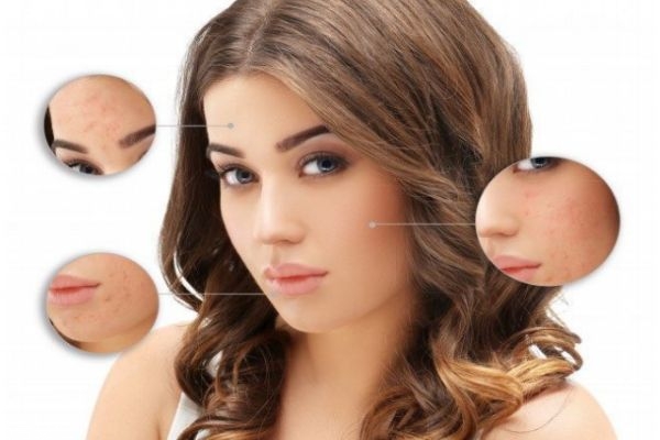 干皮長(zhǎng)痘痘是什么膚質(zhì) 干皮連續(xù)起痘的原因 干皮長(zhǎng)痘痘是什么膚質(zhì) 干皮連續(xù)起痘的原因