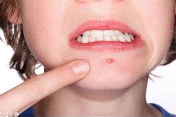 下巴上長痘痘是什么原因 下巴長痘痘怎么快速去除 下巴上長痘痘是什么原因 下巴長痘痘怎么快速去除