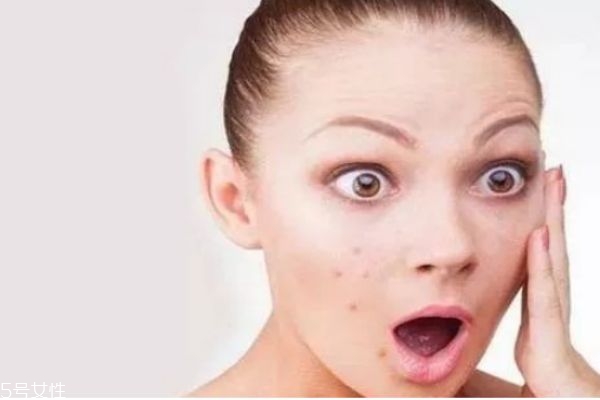 內(nèi)分泌失調(diào)下巴長痘痘怎么調(diào)理 下巴長痘痘消除小妙招 內(nèi)分泌失調(diào)下巴長痘痘怎么調(diào)理 下巴長痘痘消除小妙招