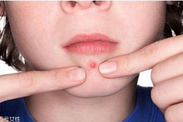 下巴長痘痘怎么辦 下巴長痘痘這樣調理 下巴長痘痘怎么辦 下巴長痘痘這樣調理