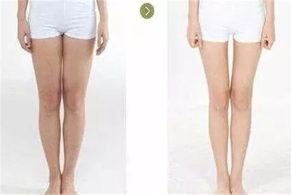 瘦腿針打幾次可以永久 瘦腿針是永久的嗎 瘦腿針打幾次可以永久 瘦腿針是永久的嗎