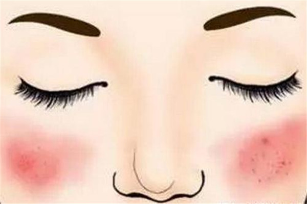 紅血絲怎么消除 紅血絲消除小偏方 紅血絲怎么消除 紅血絲消除小偏方