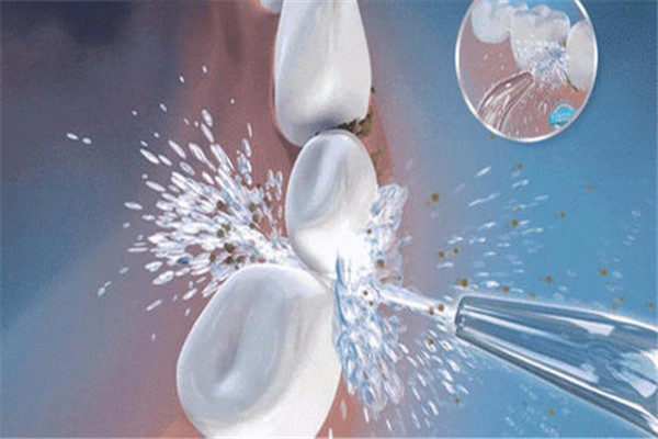洗牙是否會傷害牙釉質 洗牙是什么原理