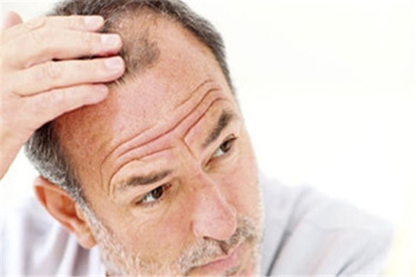 脫發(fā)是缺少什么維生素 脫發(fā)是什么原因?qū)е碌? alt=