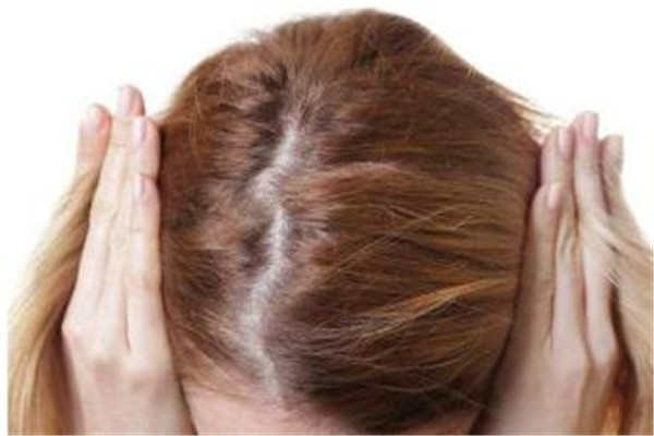 脫發(fā)是缺少什么維生素 脫發(fā)是什么原因?qū)е碌? alt=