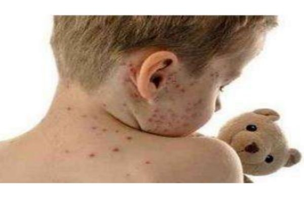 為什么會(huì)得水痘呢 得水痘有什么危害嗎 為什么會(huì)得水痘呢 得水痘有什么危害嗎