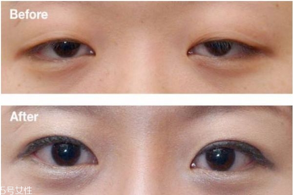 上瞼下垂矯正術治療方式 上瞼下垂矯正術優(yōu)點和缺點 上瞼下垂矯正術治療方式 上瞼下垂矯正術優(yōu)點和缺點