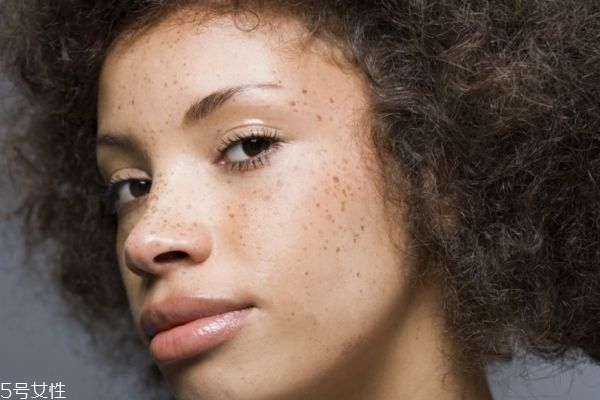 臉上的斑是怎么形成的 臉上長斑的5大原因 臉上的斑是怎么形成的 臉上長斑的5大原因