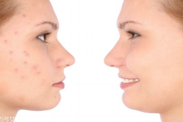 女生臉上長痘怎么調(diào)理 女生臉上長痘吃什么水果好 女生臉上長痘怎么調(diào)理 女生臉上長痘吃什么水果好