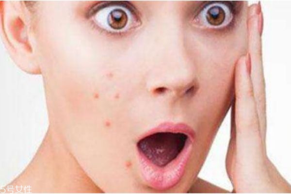 臉上經(jīng)常長痘的原因是什么 臉上痘痘長不停 臉上經(jīng)常長痘的原因是什么 臉上痘痘長不停