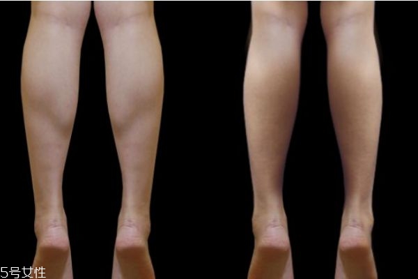 腿部抽脂要恢復多久 腿部抽脂一次多少錢