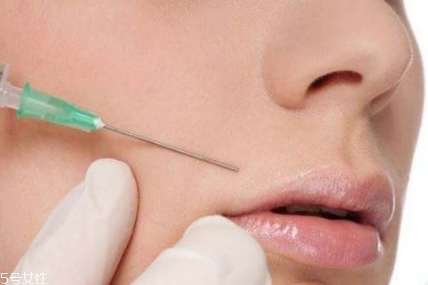 法令紋填充前后照片 填充法令紋后悔死 法令紋填充前后照片 填充法令紋后悔死