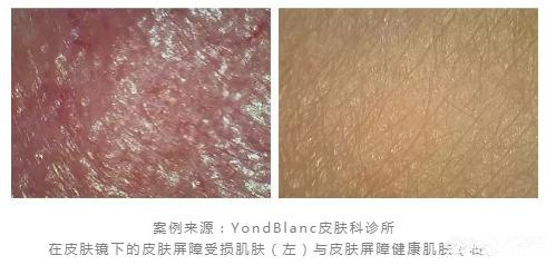 面膜敷的越多越好嗎 天天敷面膜皮膚屏障受損 面膜敷的越多越好嗎 天天敷面膜皮膚屏障受損