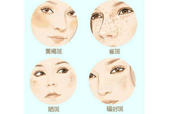 光子祛斑的原理 光子祛斑有副作用嗎 光子祛斑的原理 光子祛斑有副作用嗎