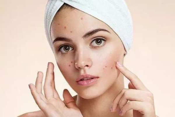 做完果酸需要注意什么 做完果酸后的護理