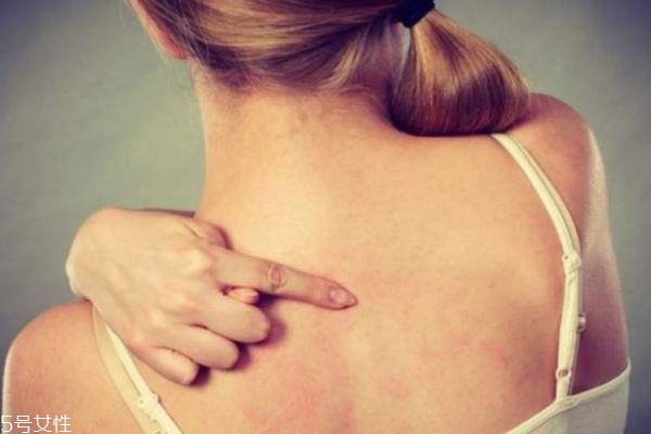 什么人群背上容易長(zhǎng)痘痘呢 什么人群背上容易長(zhǎng)痘痘呢