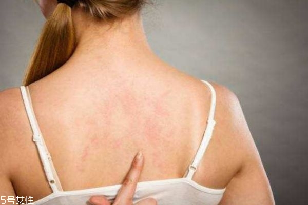 什么人群背上容易長(zhǎng)痘痘呢 什么人群背上容易長(zhǎng)痘痘呢