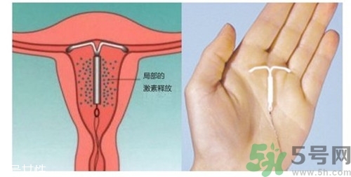 上環(huán)是什么意思？上環(huán)后注意事項(xiàng)有哪些？