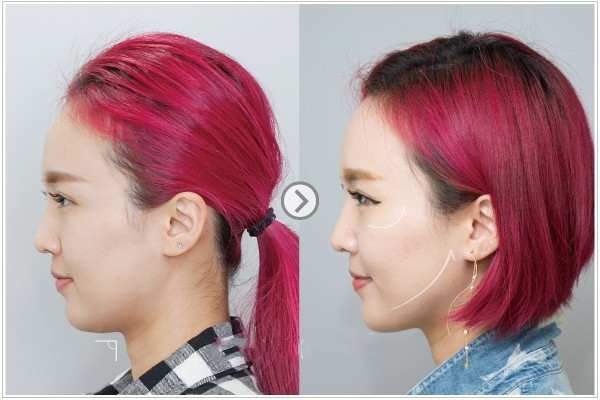 電波拉皮能保持多久 電波拉皮多久有效果 電波拉皮能保持多久 電波拉皮多久有效果