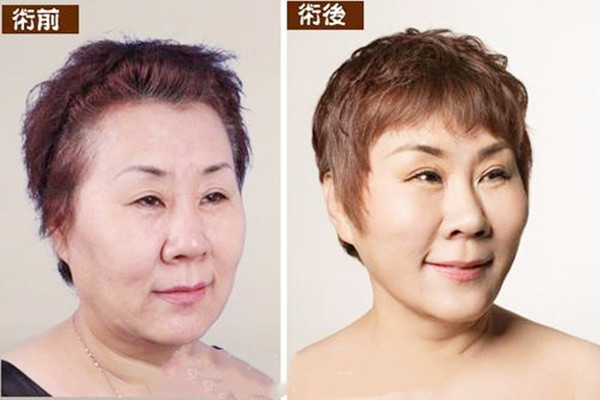 拉皮手術(shù)多久能恢復(fù) 拉皮手術(shù)會(huì)留疤嗎 拉皮手術(shù)多久能恢復(fù) 拉皮手術(shù)會(huì)留疤嗎