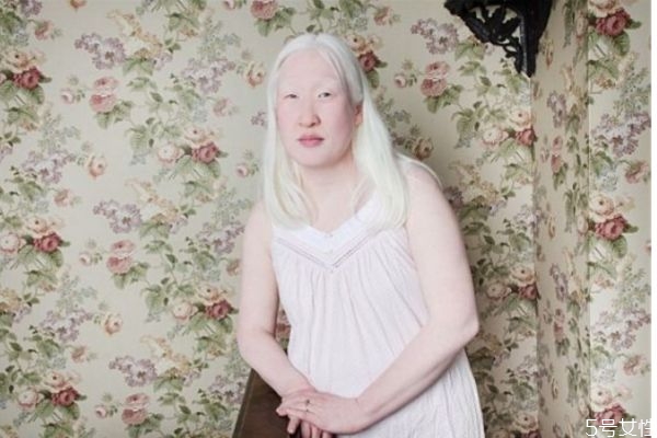 什么是白化病呢 白化病有什么危害呢