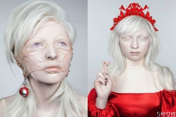 白化病是怎么引起的呢 如果預(yù)防白化病呢 白化病是怎么引起的呢 如果預(yù)防白化病呢