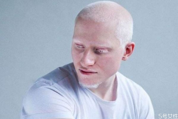 白化病是怎么引起的呢 如果預(yù)防白化病呢 白化病是怎么引起的呢 如果預(yù)防白化病呢