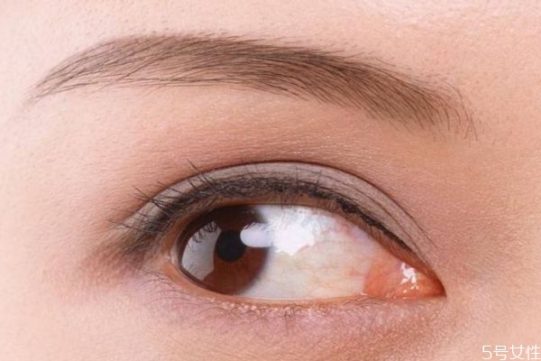 開眼角多久可以恢復(fù)呢 開眼角什么時(shí)候看沾水呢 開眼角多久可以恢復(fù)呢 開眼角什么時(shí)候看沾水呢