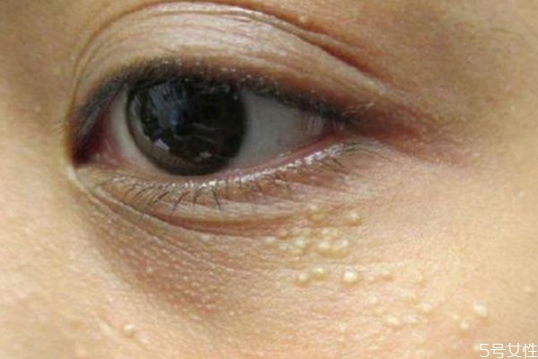 為什么涂眼霜會(huì)長脂肪粒呢 什么是脂肪粒呢 為什么涂眼霜會(huì)長脂肪粒呢 什么是脂肪粒呢