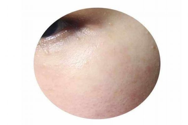 為什么涂眼霜會(huì)長脂肪粒呢 什么是脂肪粒呢 為什么涂眼霜會(huì)長脂肪粒呢 什么是脂肪粒呢