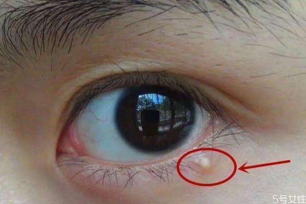 為什么涂眼霜會長脂肪粒呢 什么是脂肪粒呢