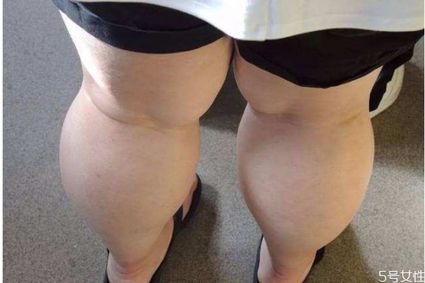 什么是大象腿呢 怎么消除大象腿呢 什么是大象腿呢 怎么消除大象腿呢