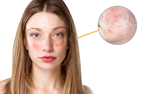 冬天臉紅發(fā)燙怎么辦 什么皮膚冬天更容易臉紅發(fā)燙 冬天臉紅發(fā)燙怎么辦 什么皮膚冬天更容易臉紅發(fā)燙