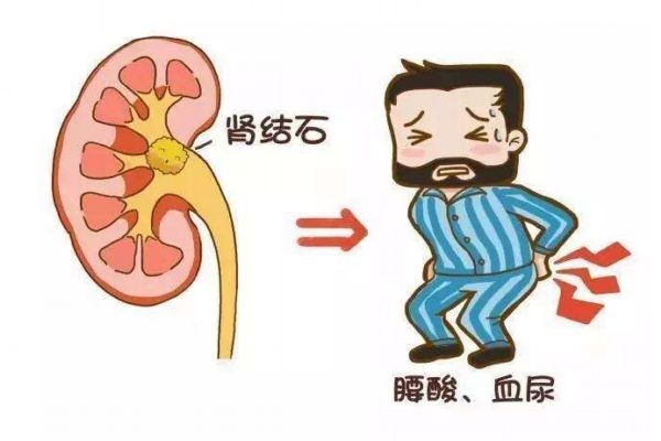 腎結(jié)石是一種什么病呢 腎結(jié)石的造成原因是什么呢 腎結(jié)石是一種什么病呢 腎結(jié)石的造成原因是什么呢