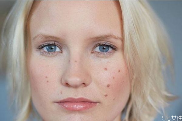 血熱長痘吃什么好 痘痘位置詳解 血熱長痘吃什么好 痘痘位置詳解