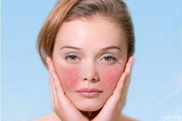 擠掉痘痘后紅腫怎么消 快速消除紅腫的痘痘 擠掉痘痘后紅腫怎么消 快速消除紅腫的痘痘
