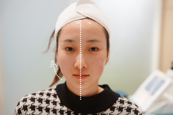 面部提升的方法有哪些 面部提升手法有哪些 面部提升的方法有哪些 面部提升手法有哪些