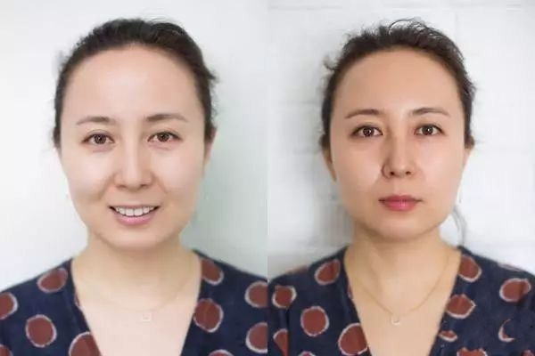 豐蘋果肌的方法有哪些 哪些人適合填充蘋果肌 豐蘋果肌的方法有哪些 哪些人適合填充蘋果肌