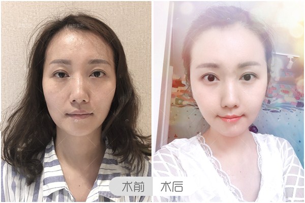 豐蘋果肌后怎么護理 豐蘋果肌的注意事項有哪些 豐蘋果肌后怎么護理 豐蘋果肌的注意事項有哪些