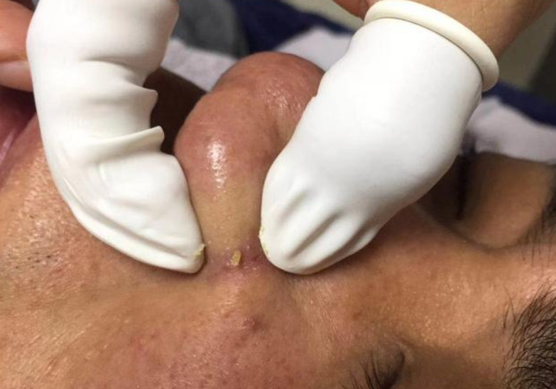 粉刺針挑痘痘還會(huì)長(zhǎng)嗎 針清痘痘真的能好嗎