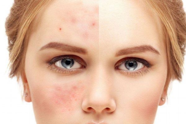 刷酸會爛臉嗎 應(yīng)該怎么正確刷酸呢 刷酸會爛臉嗎 應(yīng)該怎么正確刷酸呢