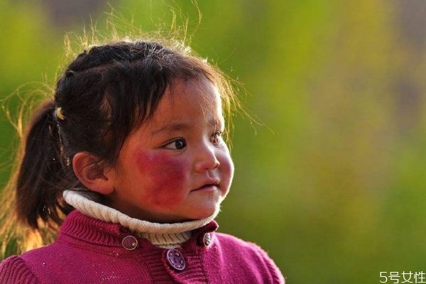 什么是高原紅呢 為什么會有高原紅呢 什么是高原紅呢 為什么會有高原紅呢