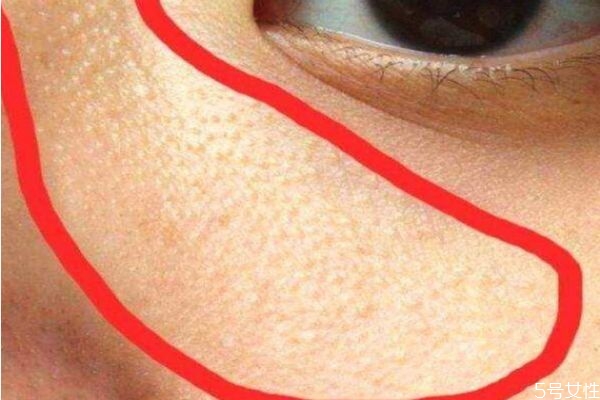 眼下有脂肪粒怎么辦 如何去處眼部脂肪粒 眼下有脂肪粒怎么辦 如何去處眼部脂肪粒