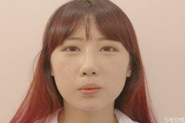 墊下巴的手術(shù)需要多久恢復(fù)呢 墊下巴有什么缺點呢 墊下巴的手術(shù)需要多久恢復(fù)呢 墊下巴有什么缺點呢