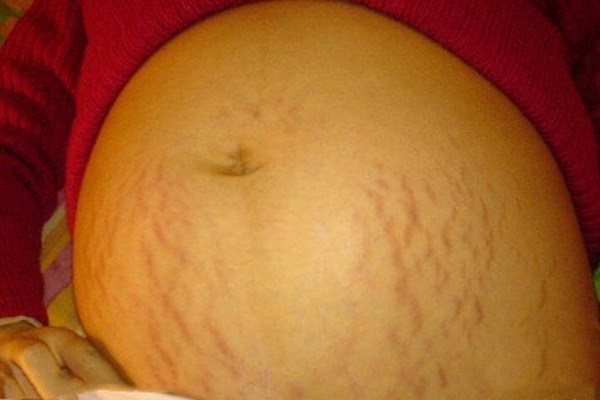 妊娠紋會(huì)長(zhǎng)在脖子上嗎 為什么會(huì)形成妊娠紋 妊娠紋會(huì)長(zhǎng)在脖子上嗎 為什么會(huì)形成妊娠紋