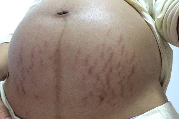 妊娠紋會(huì)長(zhǎng)在脖子上嗎 為什么會(huì)形成妊娠紋 妊娠紋會(huì)長(zhǎng)在脖子上嗎 為什么會(huì)形成妊娠紋